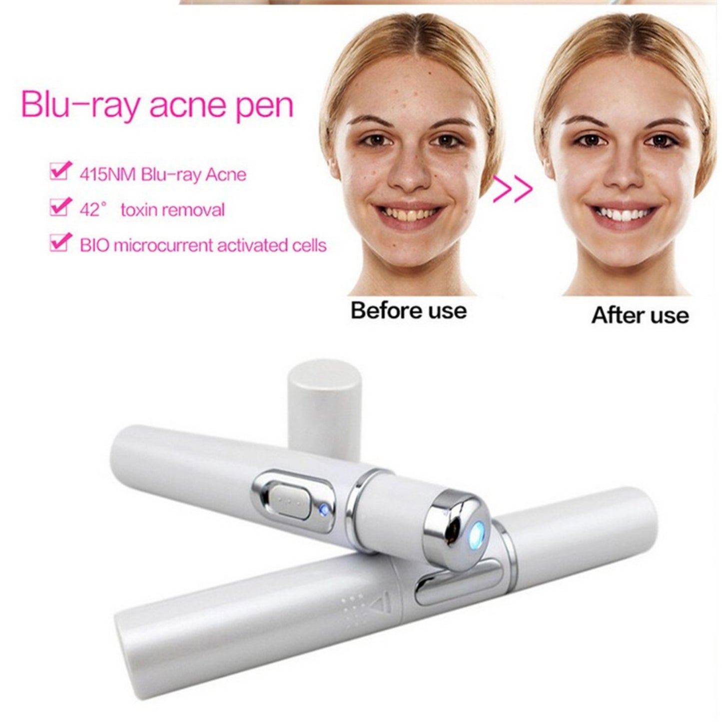 Blauwlichttherapie Acne Laserpen - Zacht Littekens en Rimpels Verwijderingsapparaat